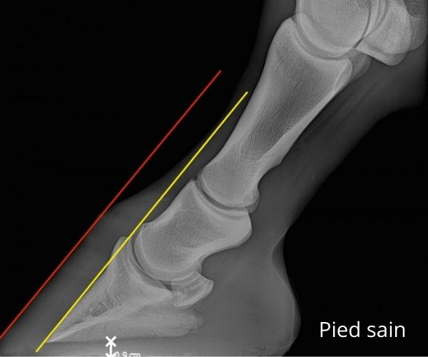 Radiographie d'un pied de cheval sain, la paroi et la 3 eme phalange étant parallèles
