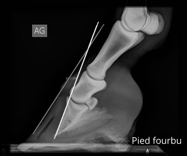 Radiographie d'un pied fourbu, la 3 ème phalange étant basculée